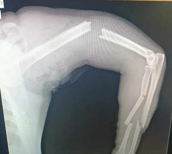 Closed Fracture