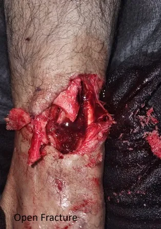 Open Fracture